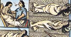 Smallpox
